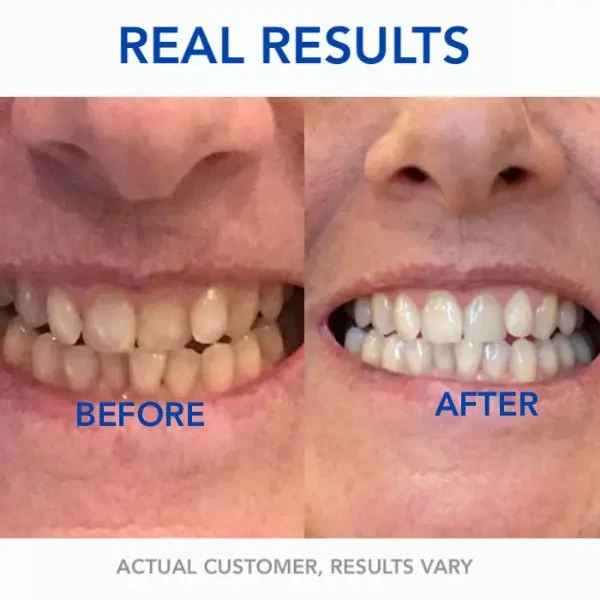 SmileBeam™ Wireless Teeth Whitening Kit - Image 7
