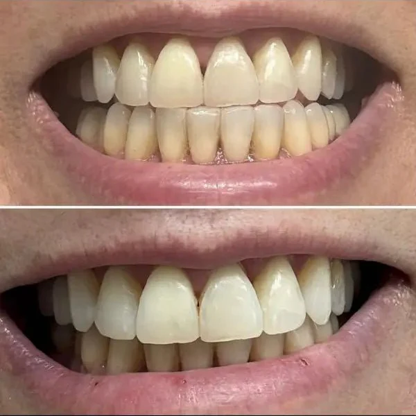 SmileBeam™ Wireless Teeth Whitening Kit - Image 8